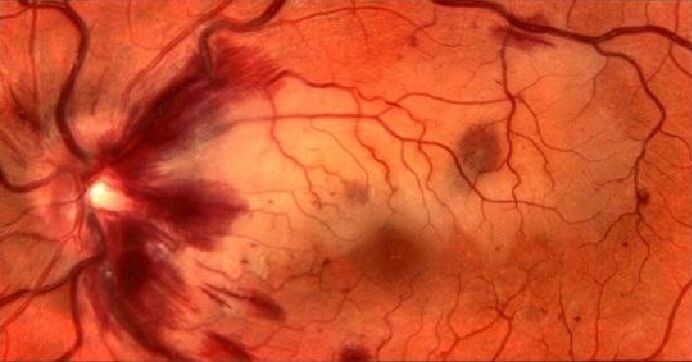 retinale bloedvaten en herstel van het gezichtsvermogen